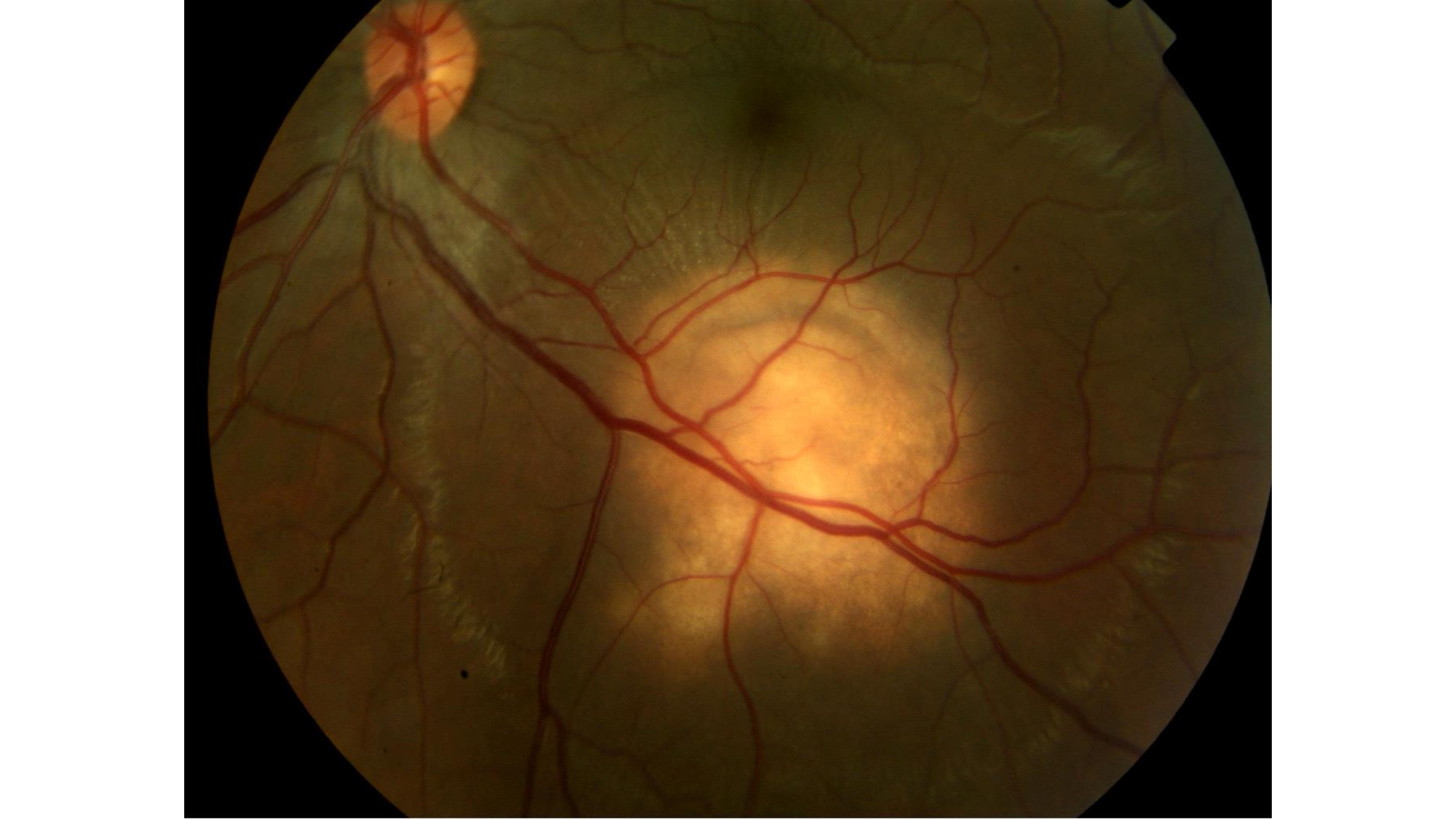 <p>Tubercular Choroidal Granuloma