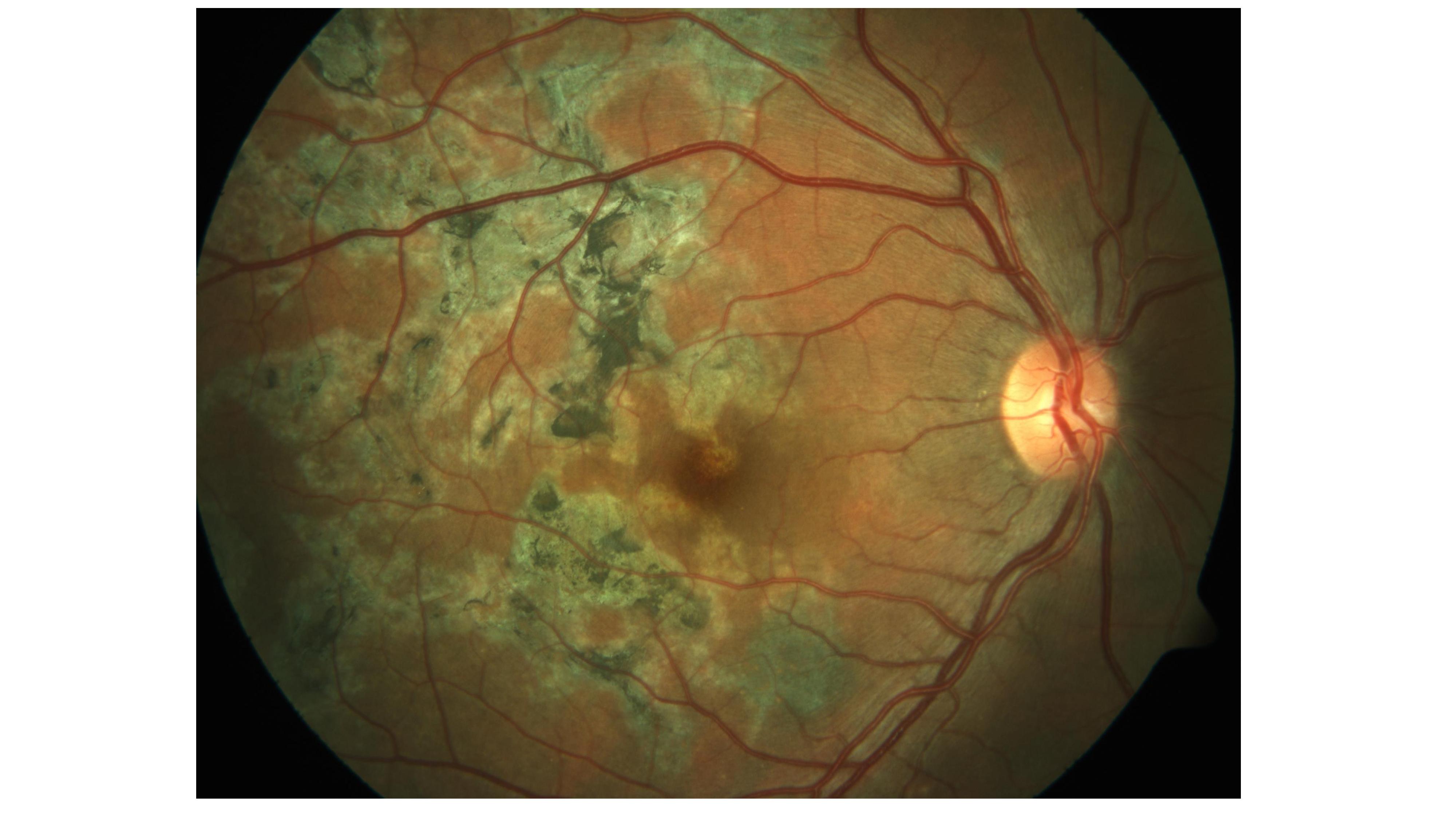 <p>Tubercular Serpigionous-Like Choroiditis