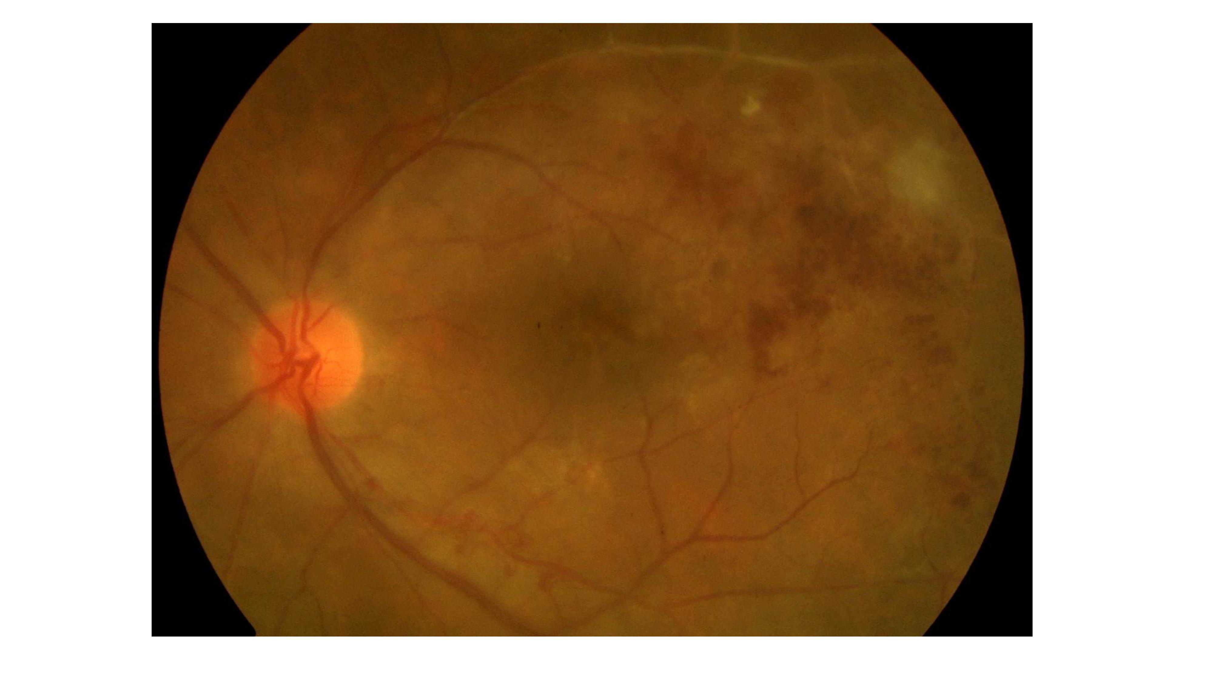 TB delayed hypersensitivity uveitis (Eales’ disease) presenting with hemorrhagic ischemic vascular occlusion. Note the retinal hemorrhages and the vascular obliteration and sheathing temporal to the macula. 