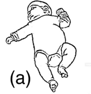 Asymmetrical tonic neck reflex elicited by rotating the head to one side causing ipsilateral extension of the extremities towards which the face is turned and contralateral flexion of extremities