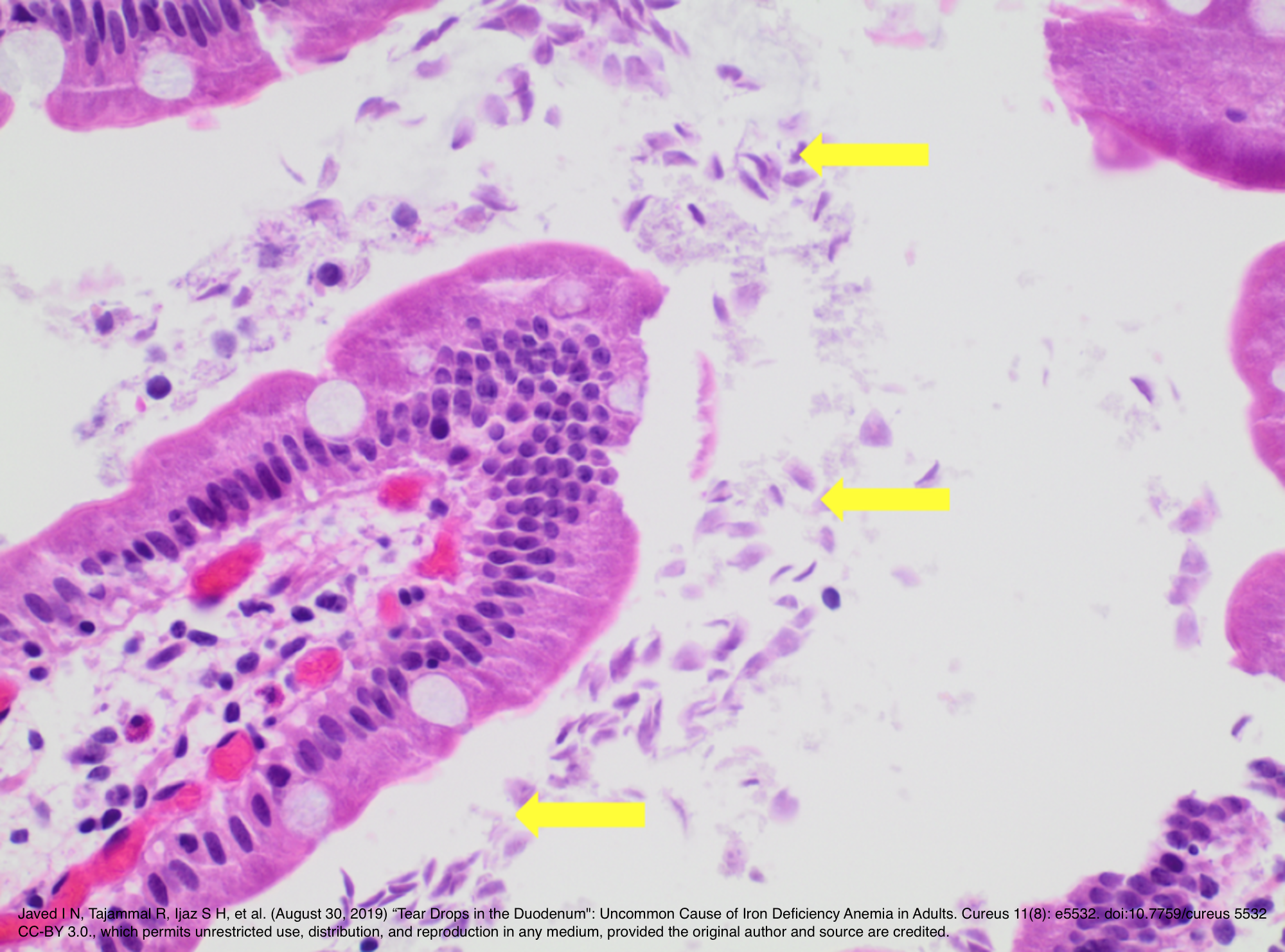 H&amp;E at 40x showing Giardia duodenalis surrounding the entire villus.