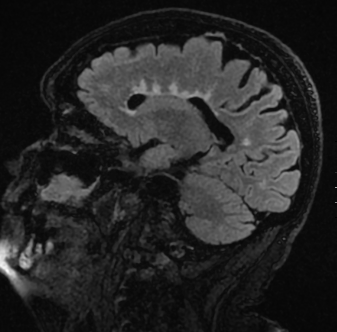 Multiple sclerosis: linear hyperintense lesions on a saggital AXIAL sequence. These lesions are arranged perpendicular to the left lateral ventricle("Dawson's fingers").