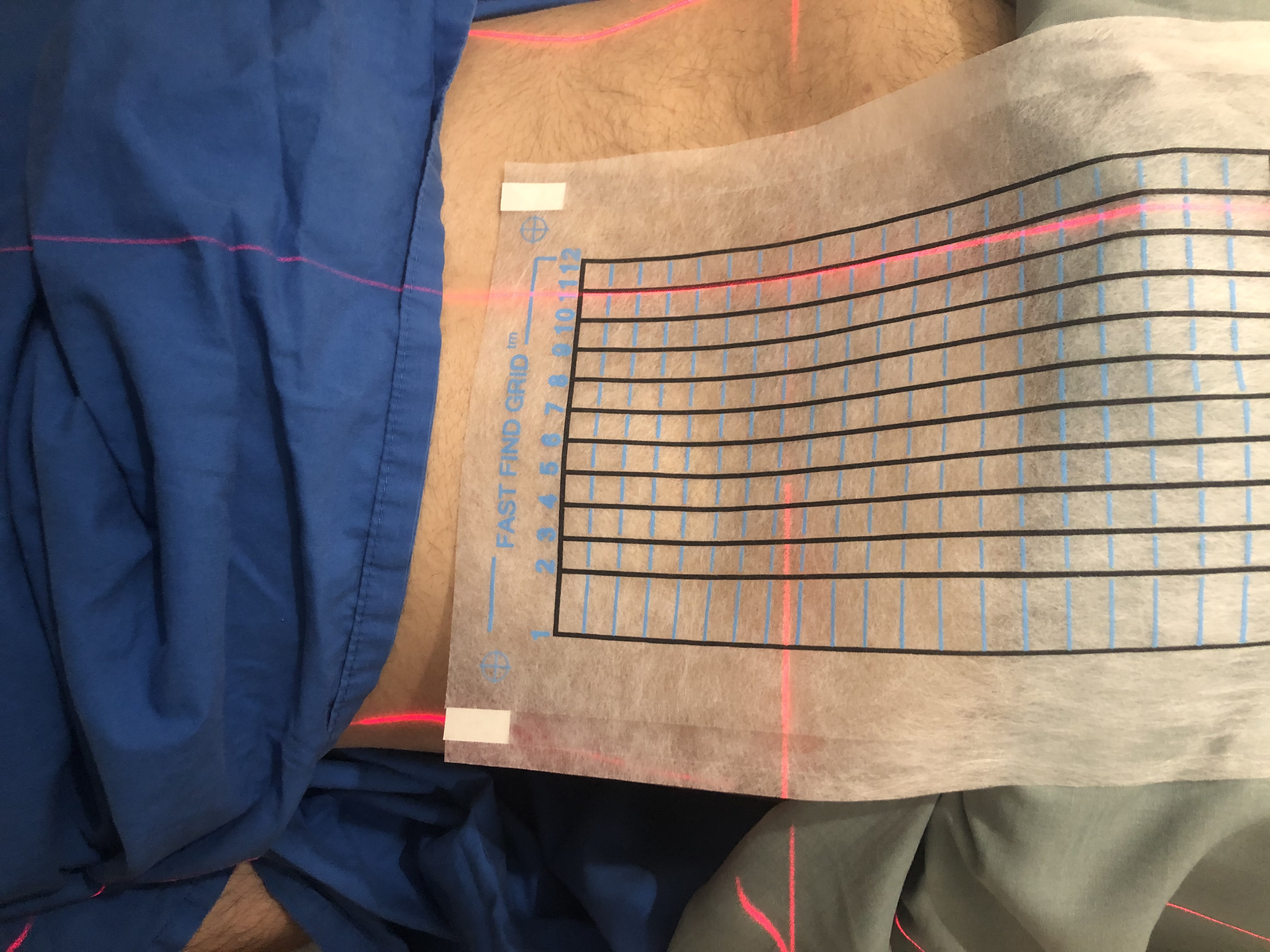 Sacroiliac joint injection: a grid being used.