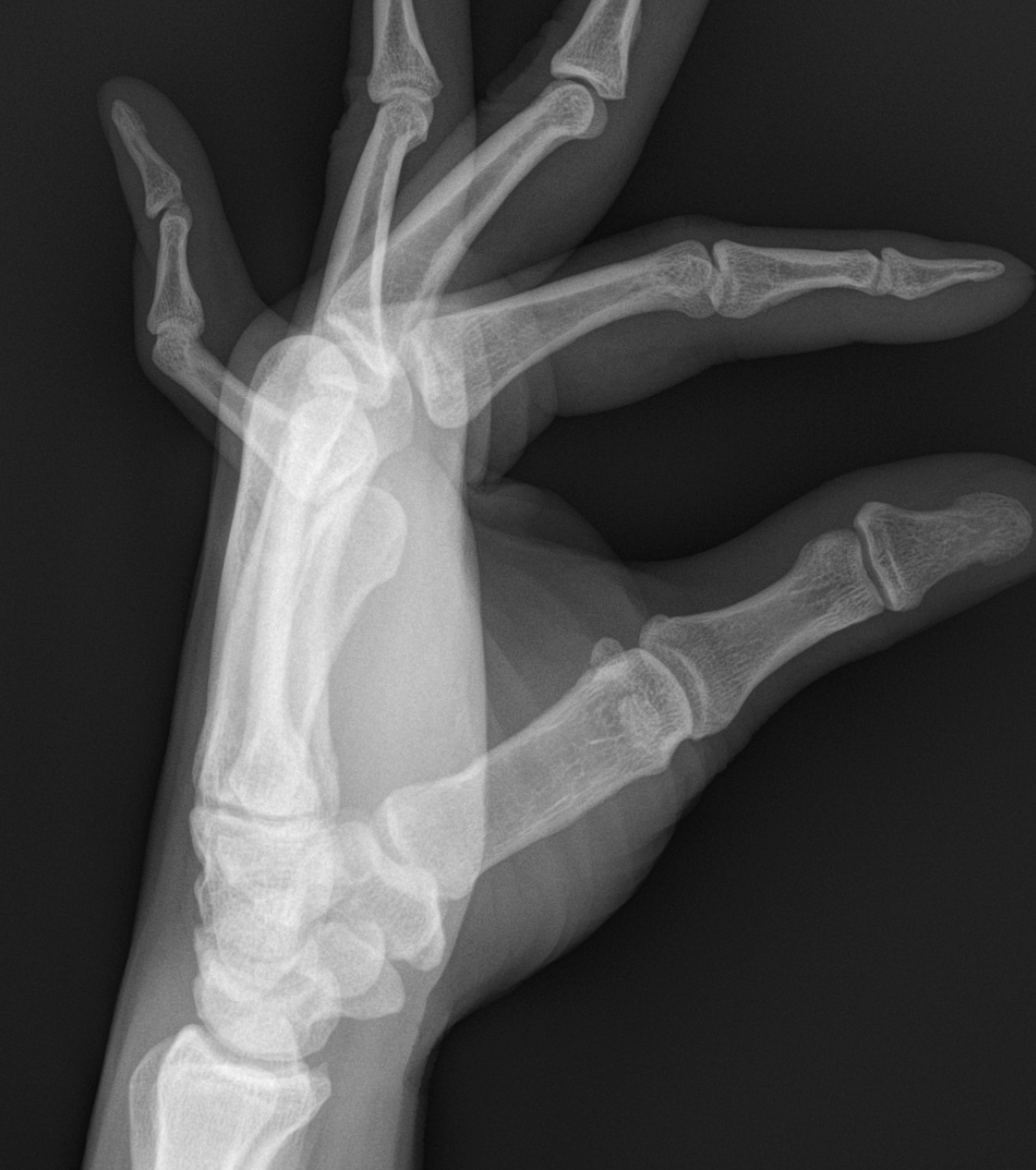 Boutonniere deformity of the 5th digit.