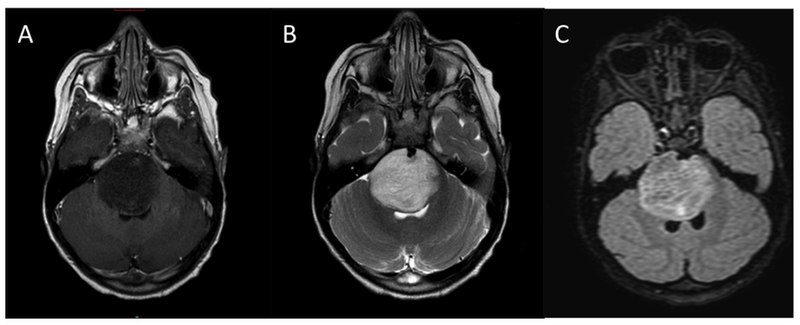 Typical MRI appearance of diffuse intrinsic pontine glioma (DIPG). (A) T1-weighted post contrast, (B) T2-weighted, (C) FLAIR.