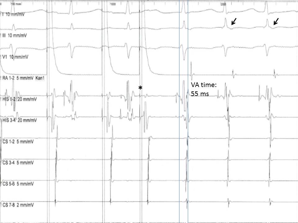 Figure 5.  Induction of an atrioventricular nodal reentry tachycardia (AVNRT) with a premature atrial extra stimulus (asterisk).  Note the short VA time (<60 ms) in the His bundle recording and the retrograde P waves in the ECG leads (arrows)