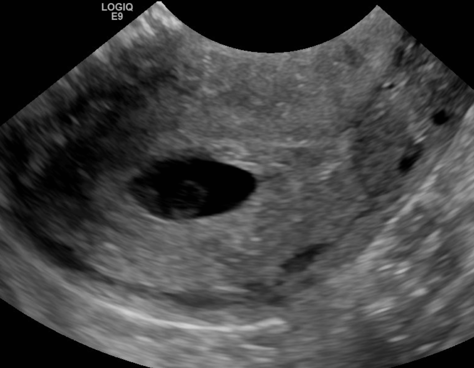 <p>Anembryonic Pregnancy