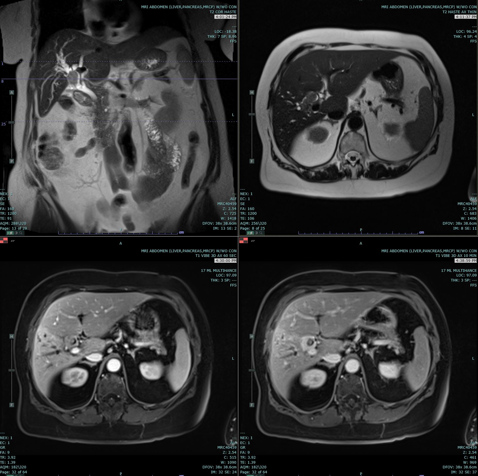 <p>Cholangiocarcinoma