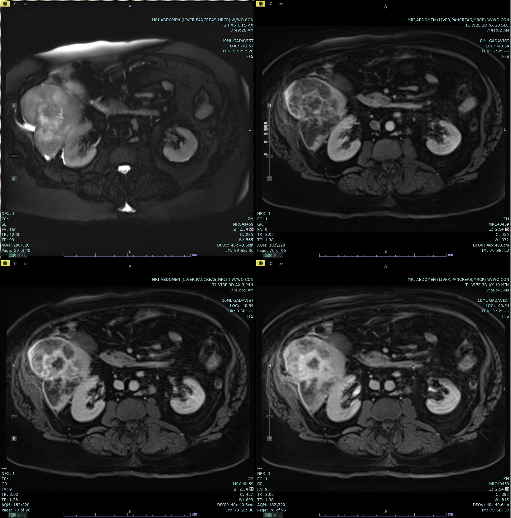 Axial T2 Haste, and 20s, 3 minute and 10 minute post contrast T1 Vibe images are submitted. There is a delayed enhancing mass in segment 7 of the right hepatic lobe which is biopsy proven to be cholangiocarcinoma. This mass has increased T2 signal in comparison to the background liver parenchyma. 