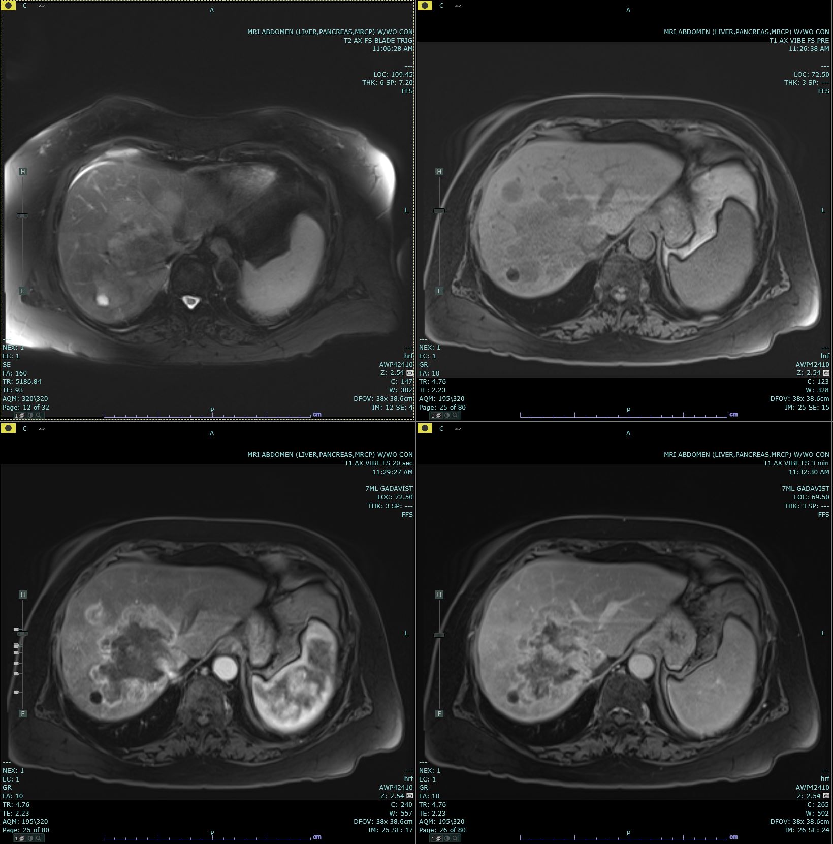 Axial T2 Haste, Pre T1 Vibe, and 20 second and 3 minute post contrast T1 Vibe images are submitted