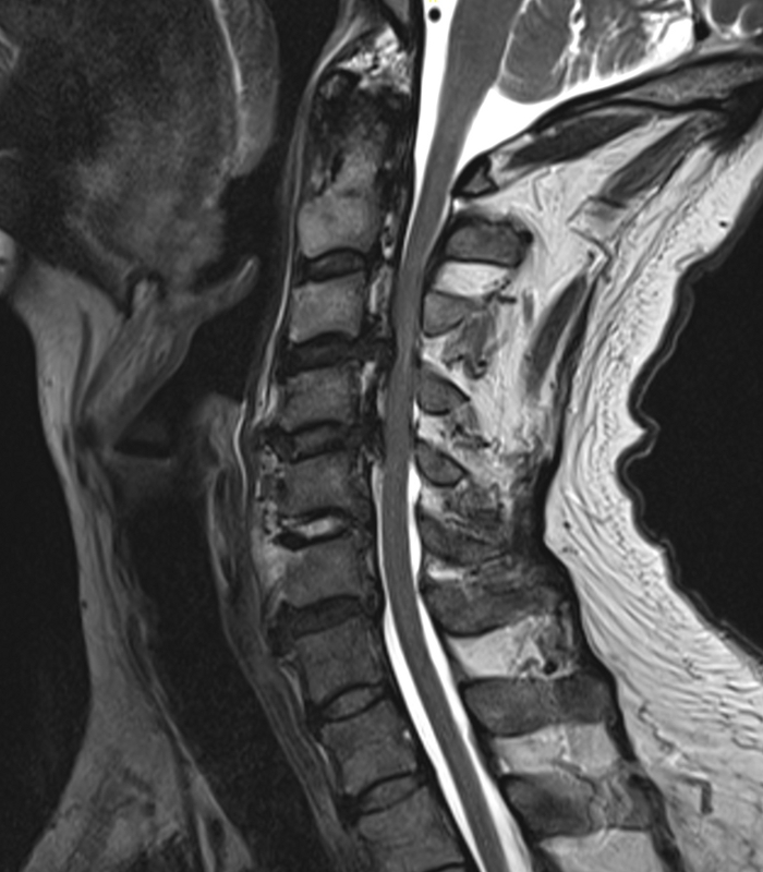 OPLL (Ossification of the posterior longitudinal ligament)