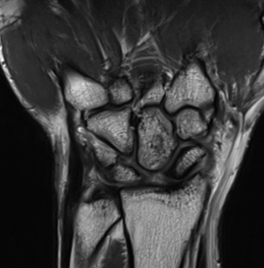 <p>Scapholunate Advanced Collapse T1 Sequence