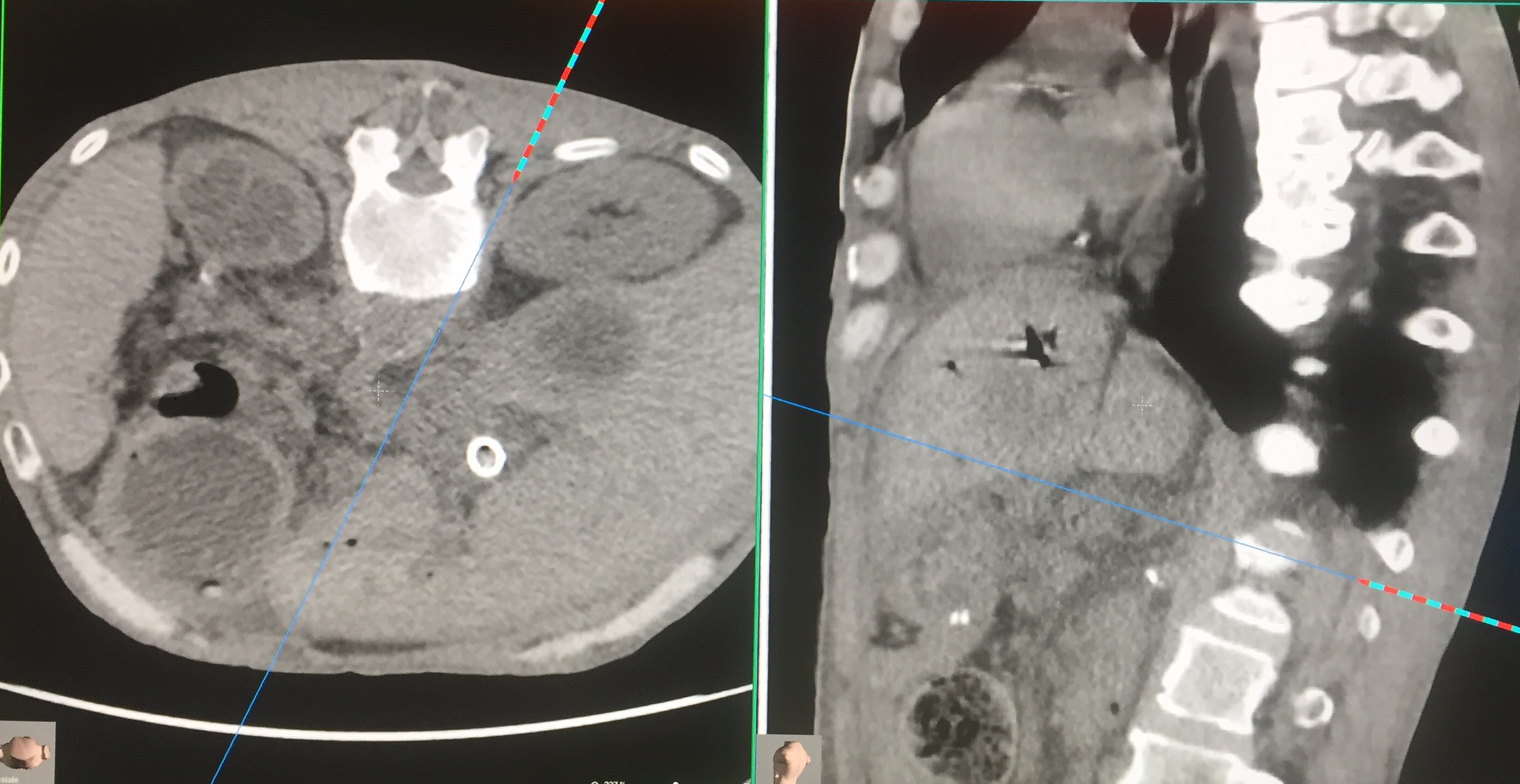 Celiac Ganglion Block