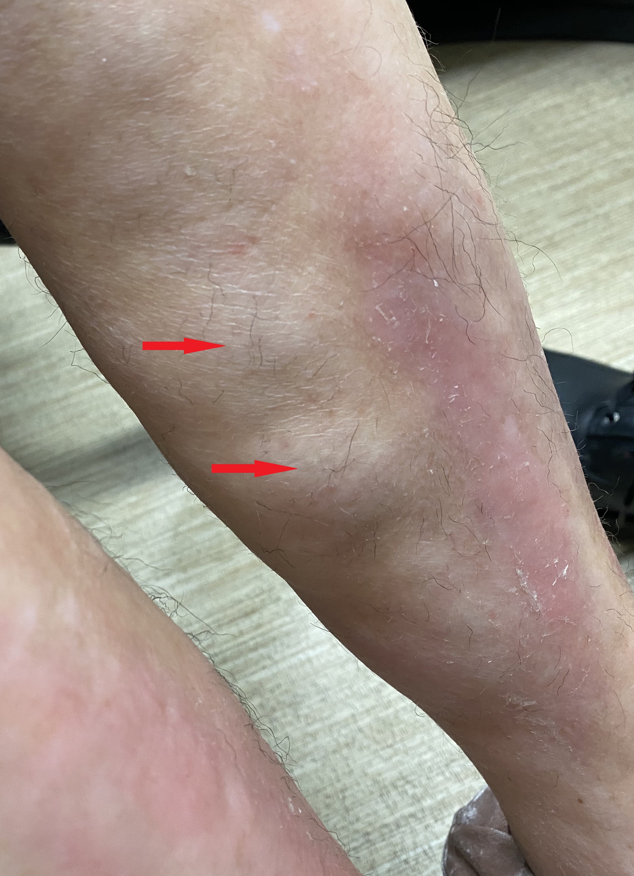 Extensive involvement of the skin of the lower extremities showing nodular areas of hypopigmentation, alopecia, and sclerosis (red arrows)