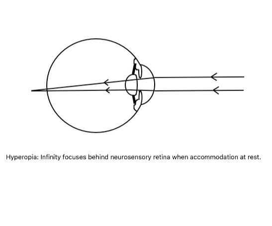 Hyperopia: parallel light rays from infinity focuses behind the retina when accommodation at rest