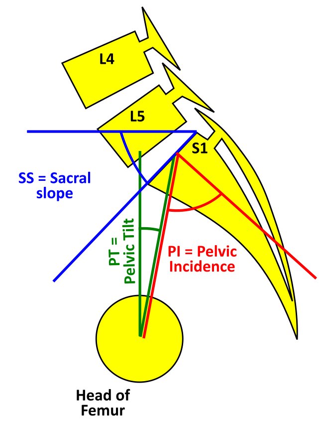Spino pelvic parameters showing Pelvic tilt (PT), Sacral slope (SS) and Pelvic incidence (PI). Pelvic incidence (PI) = Pelvic tilt (PT) + Sacral slope (SS)