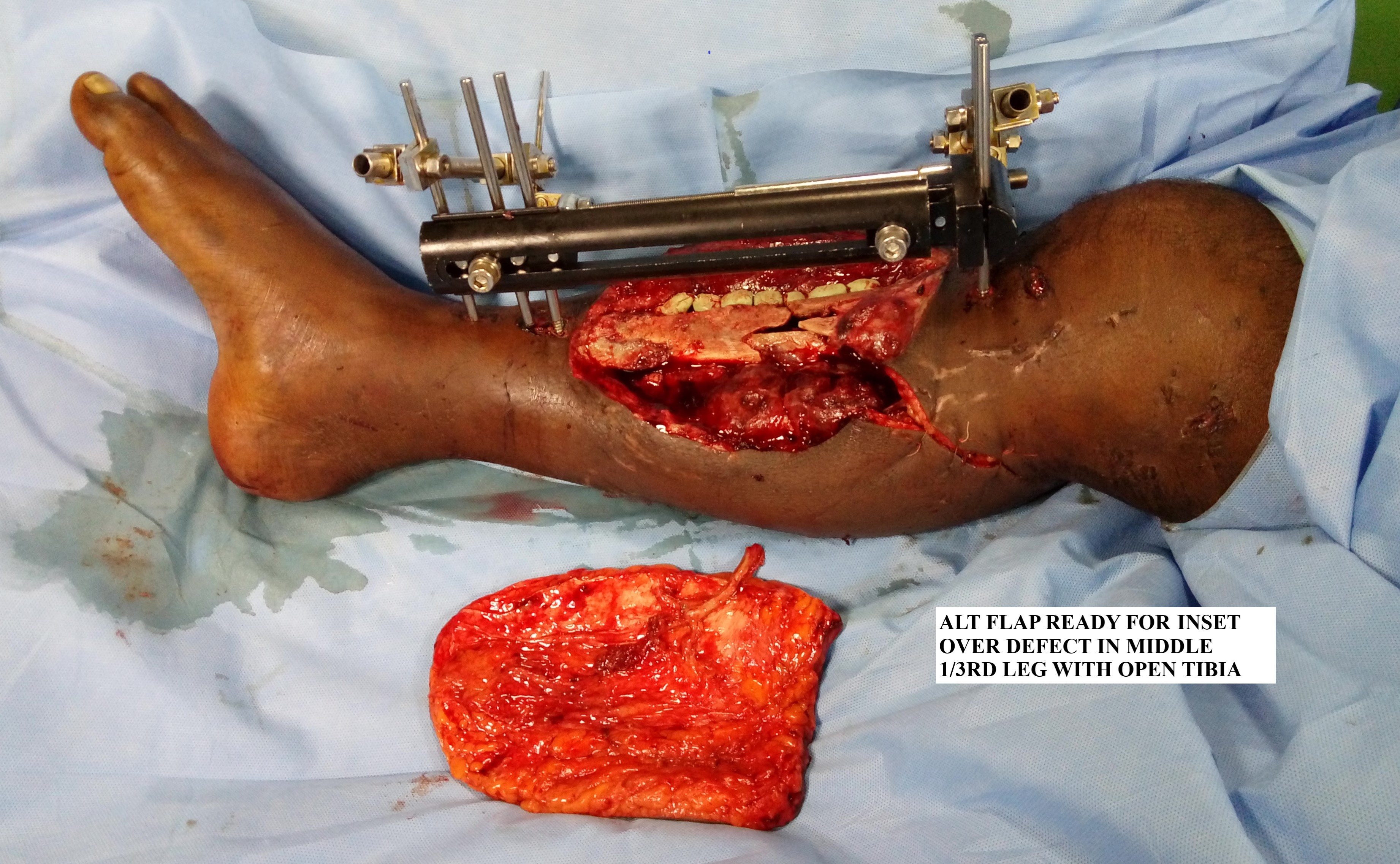 ALT FLAP BEFORE INSET OVER DEFECT IN MIDDLE 1/3 RD LEG