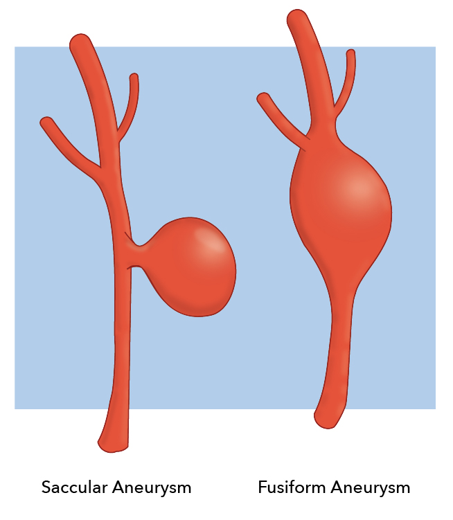 <p>Berry Aneurysm</p>