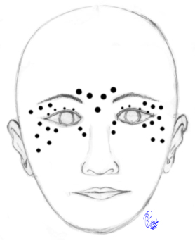 <p>Botulinum Toxin Injections for Blepharospasm