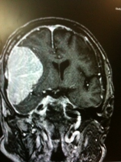 Convexity meningioma