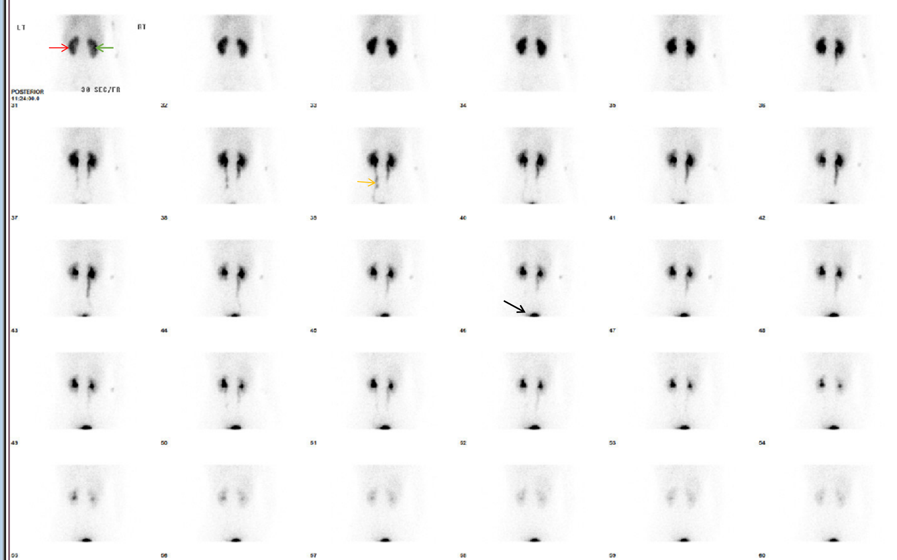 Normal 99Tcm-Mag3 renal scan: Posteriorly acquired images, obtained every 30 seconds after injecting nuclear agent Tc-99m-Mag3