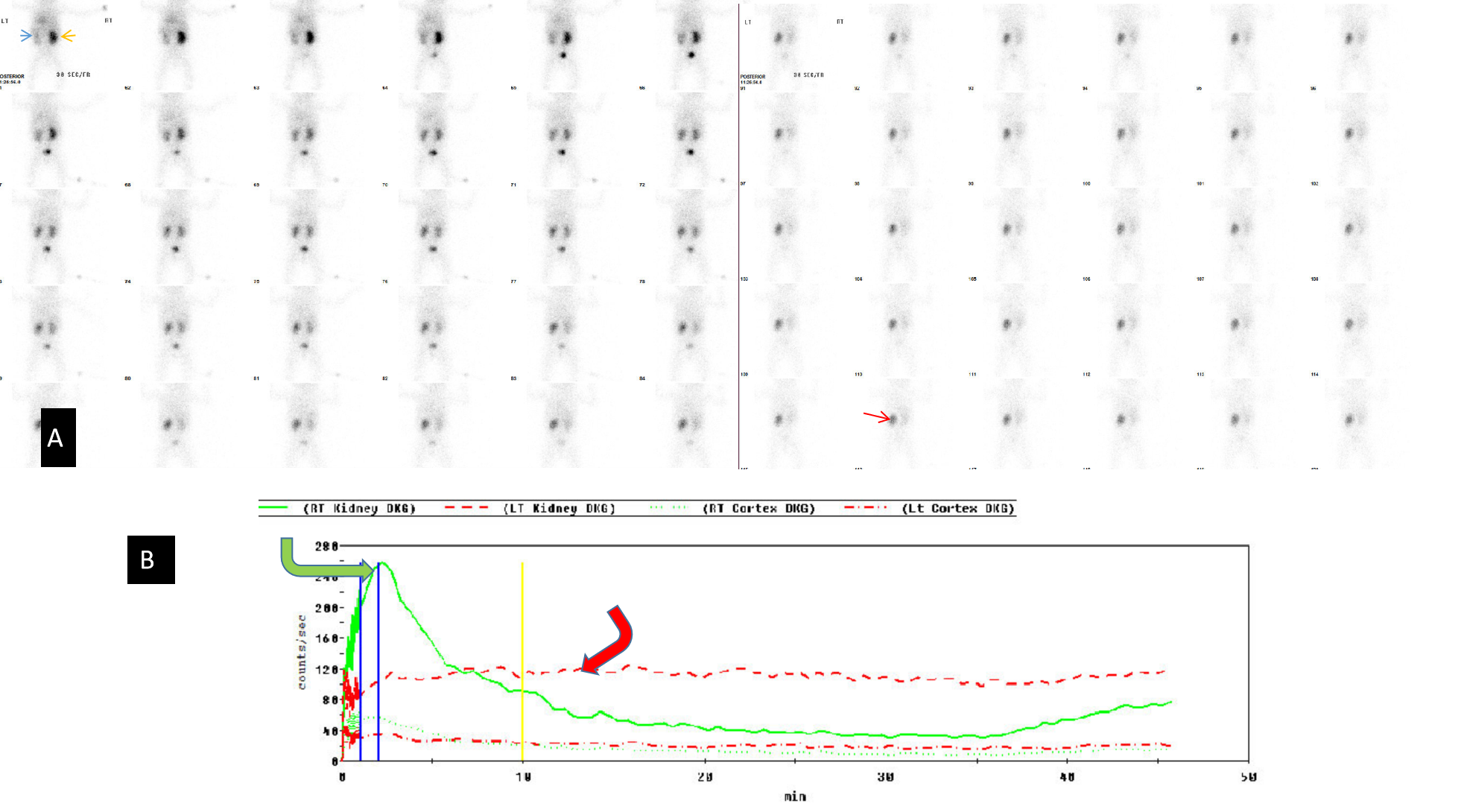 99Tcm-Mag3 renal scan: Left kidney (LK) obstruction