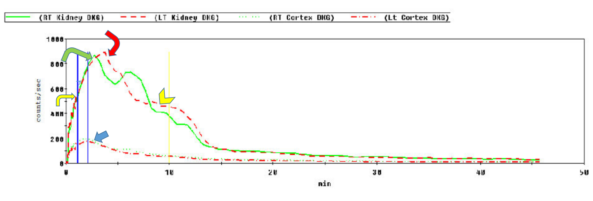 99Tcm-Mag3 renal scan: Time activity determined for each kidney, separately