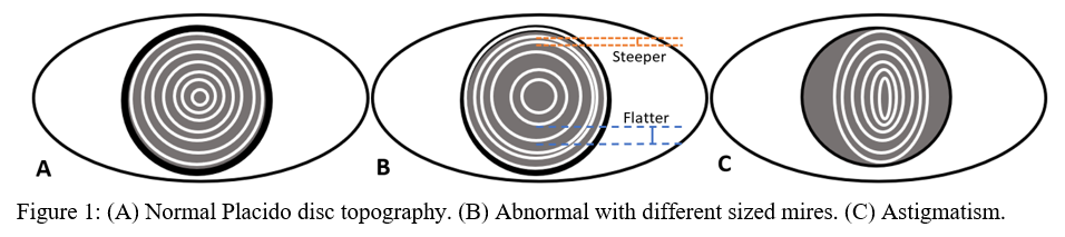 Placido disc topography