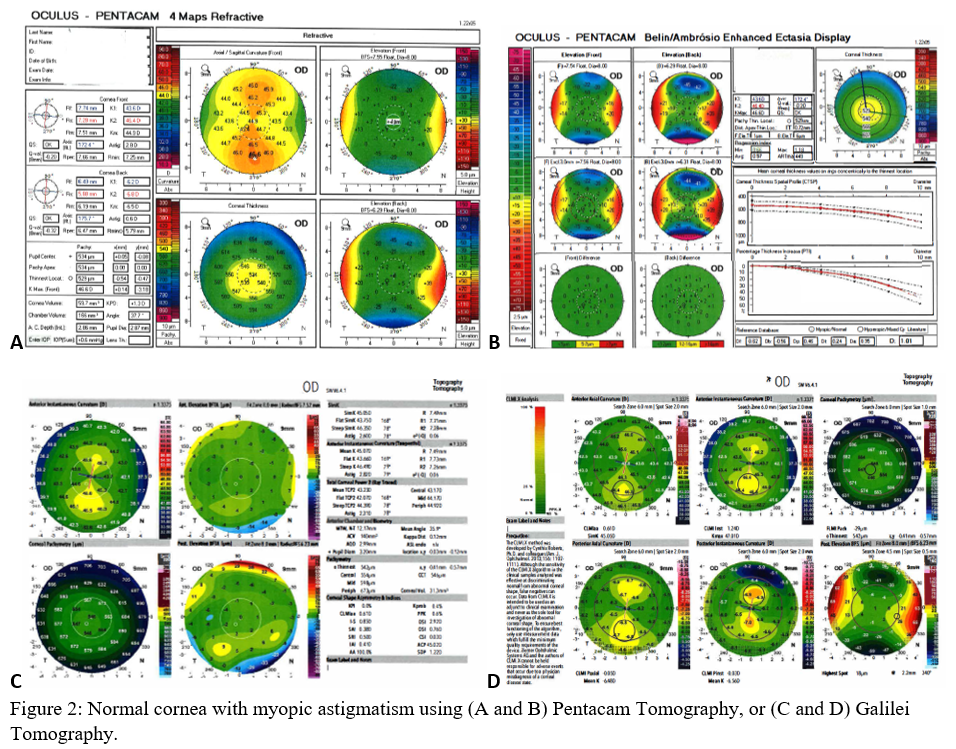 Normal cornea with myopic astigmatism