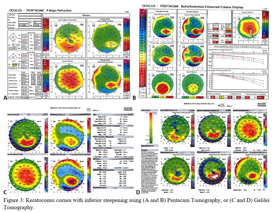 Keratoconus cornea with inferior steepening