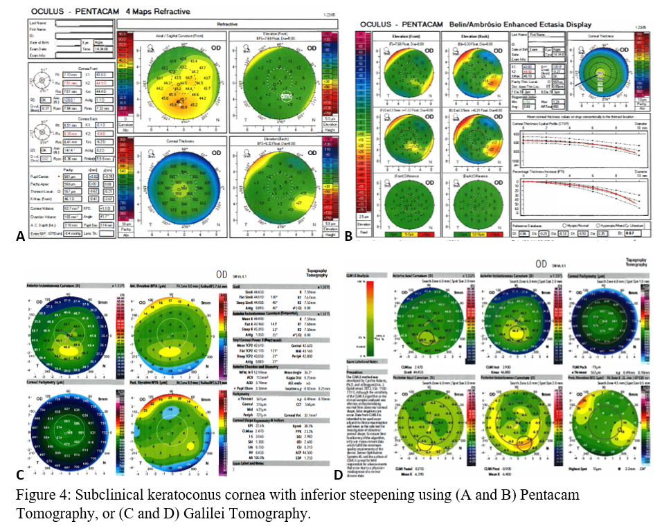 Subclilnical keratoconus cornea with inferior steepening