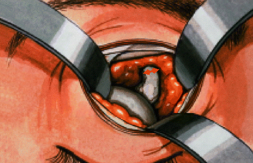 Enucleation: technique of the supero-medial approach to the optic nerve so that the optic nerve may be cut under direct vision, thereby avoiding the risk of transecting the globe in the presence of an introcular tumor. it also allows one to obtain an adequate length of the optic nerve