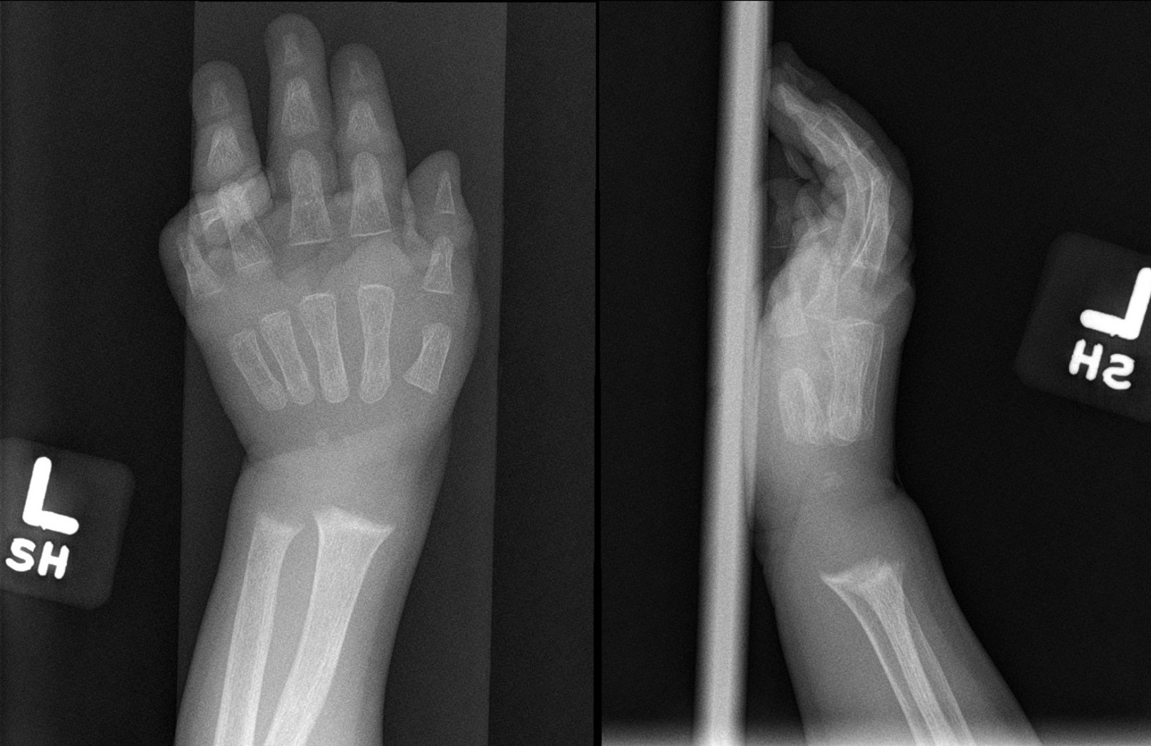 Radiograph of the left wrist (anteroposterior and lateral views) showing metaphyseal widening and irregularity of the distal radius and ulna indicative of rickets 
