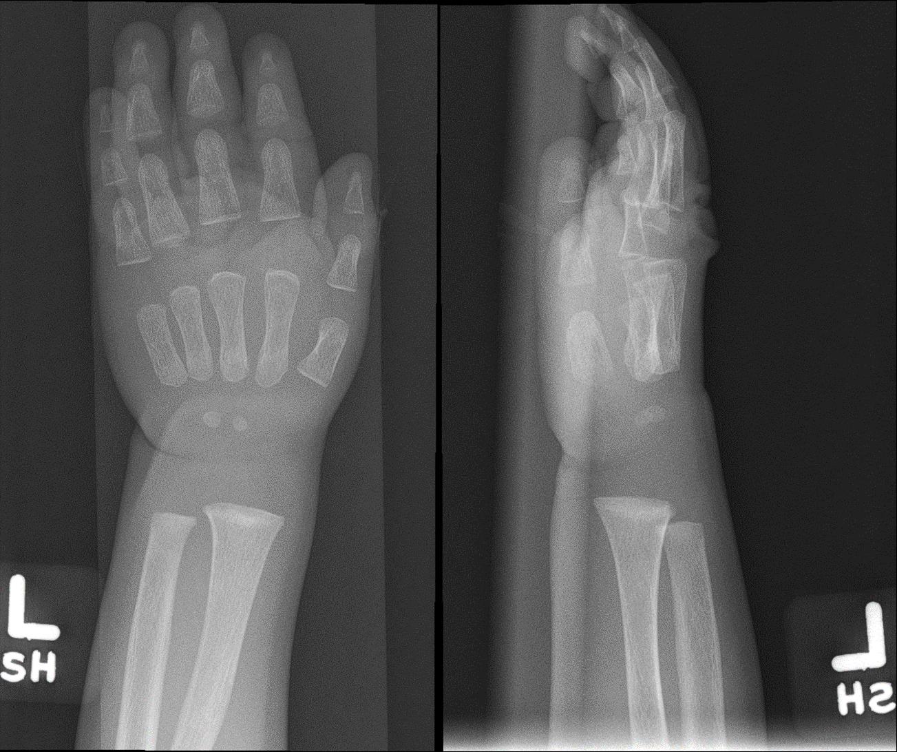 Radiograph of the left wrist (anteroposterior and lateral views) taken three months later showing improved density and appearance of the distal metaphysis after initiation of treatment for rickets. Improved mineralization of the bones also seen.

