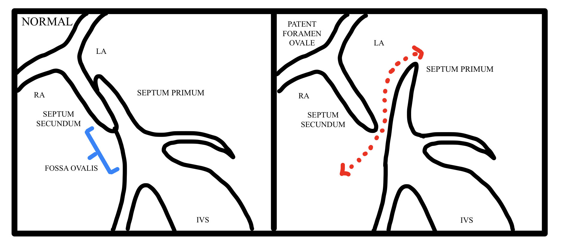 Patent foramen ovale