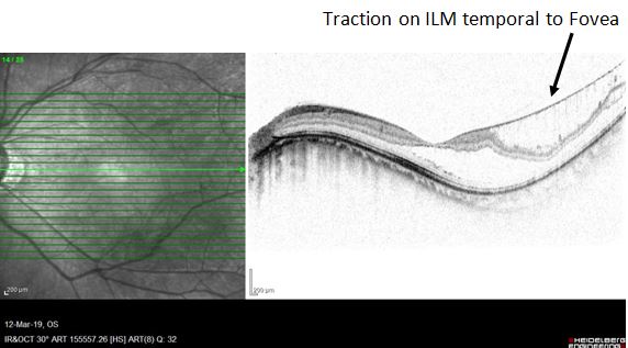 <p>Traction on the Internal Limiting Membrane: Temporal to Fovea