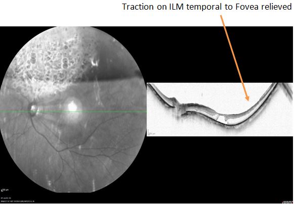 <p>Relieved Traction on the Internal Limiting Membrane After Surgery