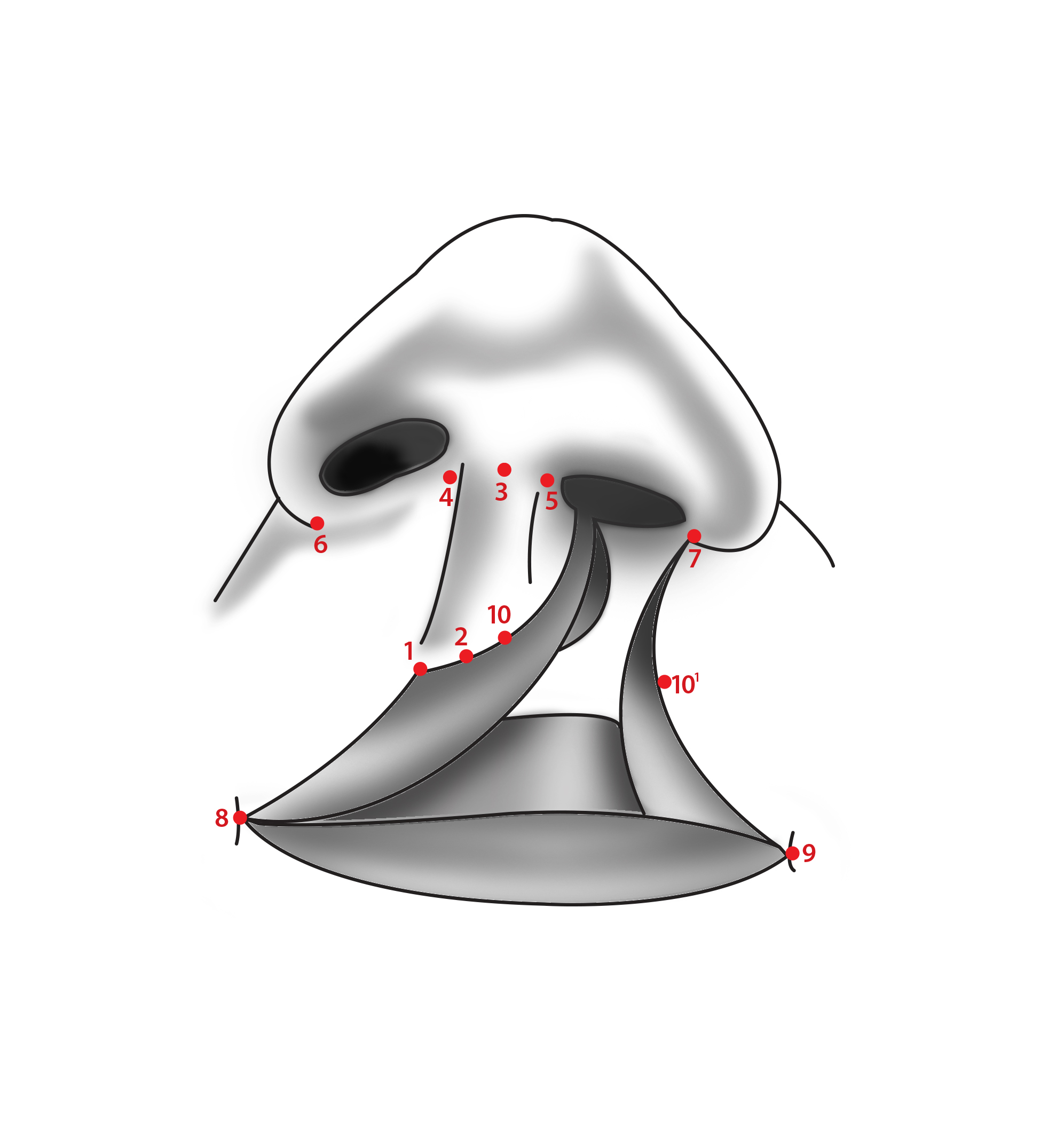 Figure 1. Cleft lip anatomic landmarks.