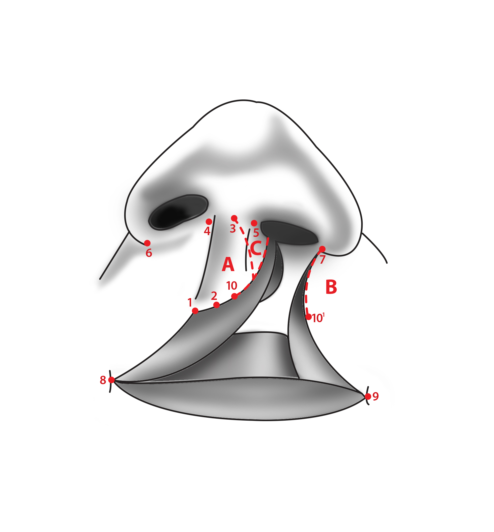 Figure 2. Millard rotation-advancement technique incision lines.