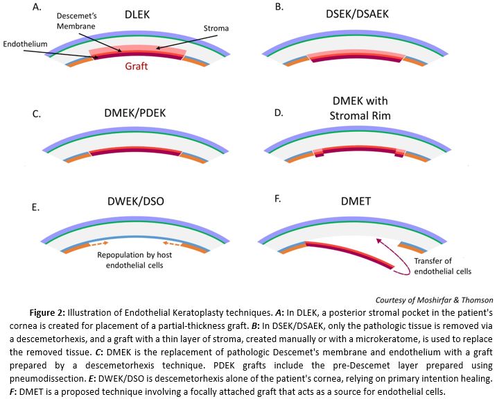 Figure 2: Illustration of Endothelial Keratoplasty Techniques