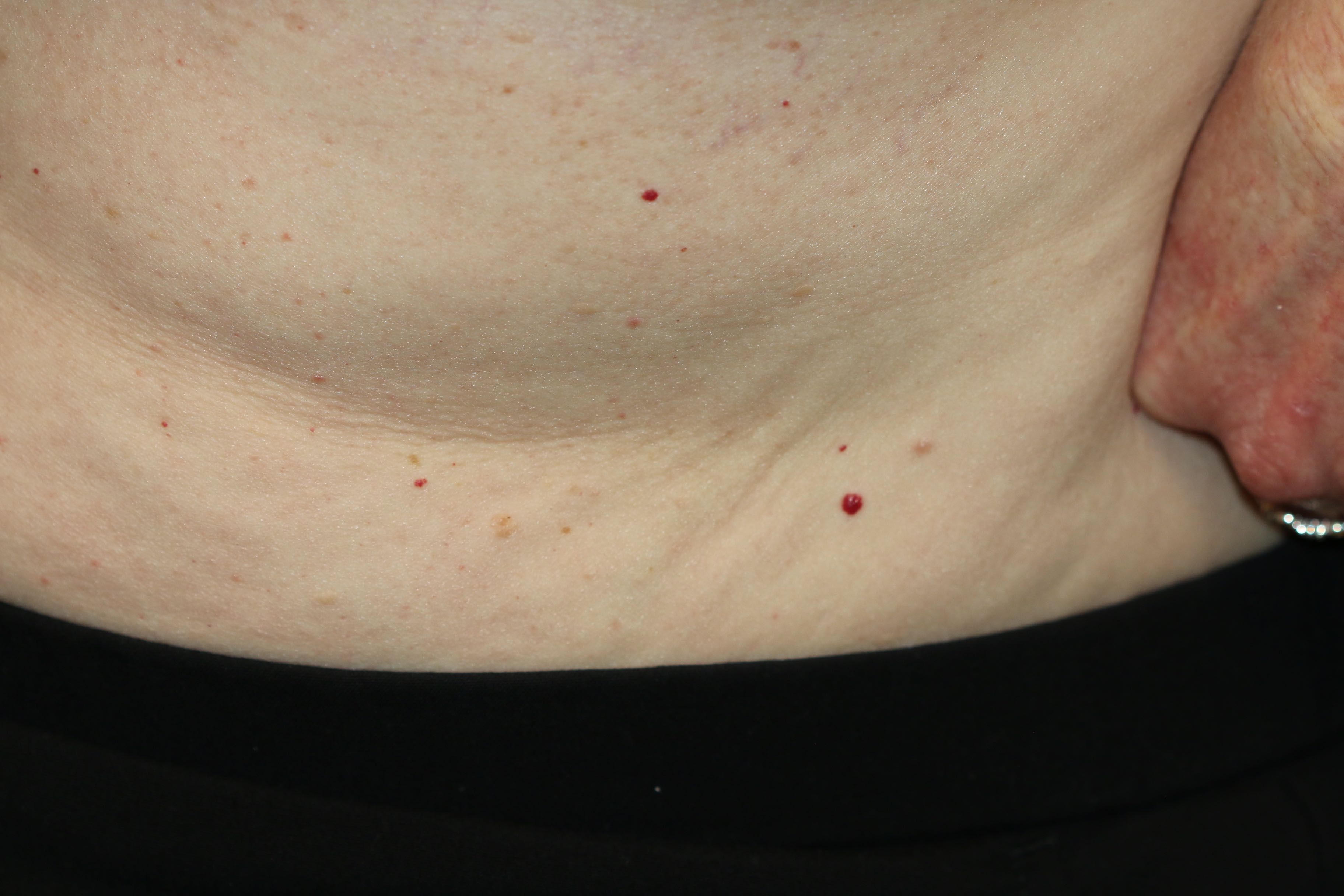 <p>Cherry Hemangioma. Campbell de Moran spots (cherry hemangiomas) are seen on the trunk of a 78-year-old female.</p>