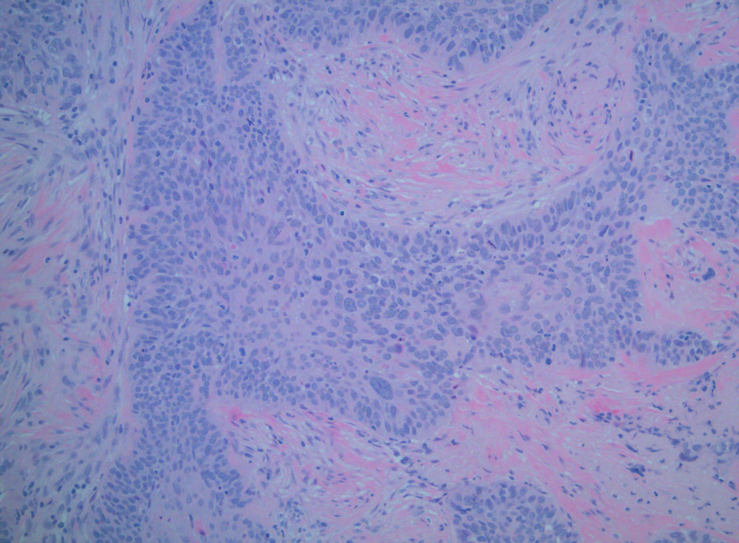 Squamous Cell Carcinoma (SCC) of the palate without P16 staining