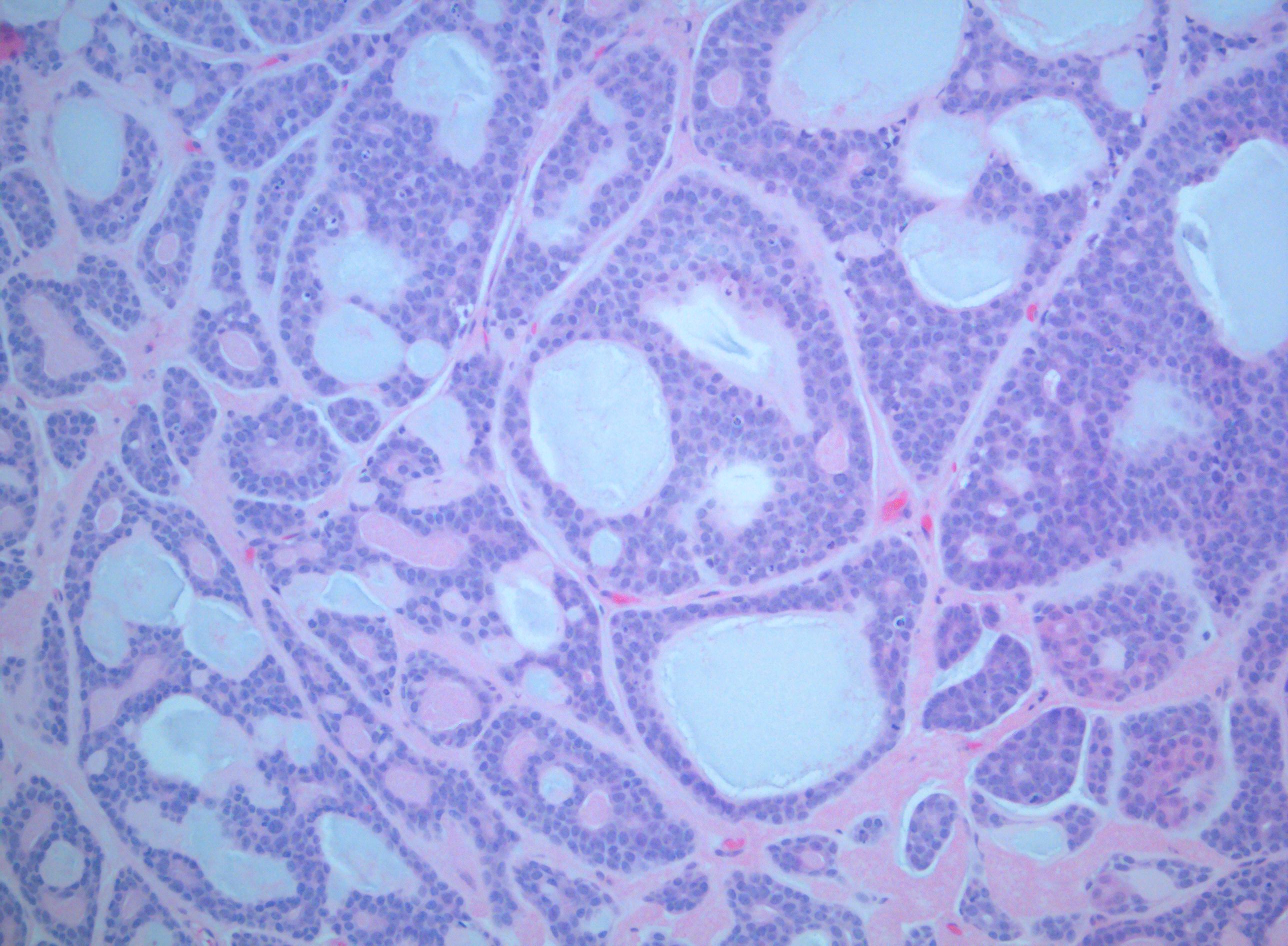 Acinic Cell Carcinoma (ACC) of the Palate