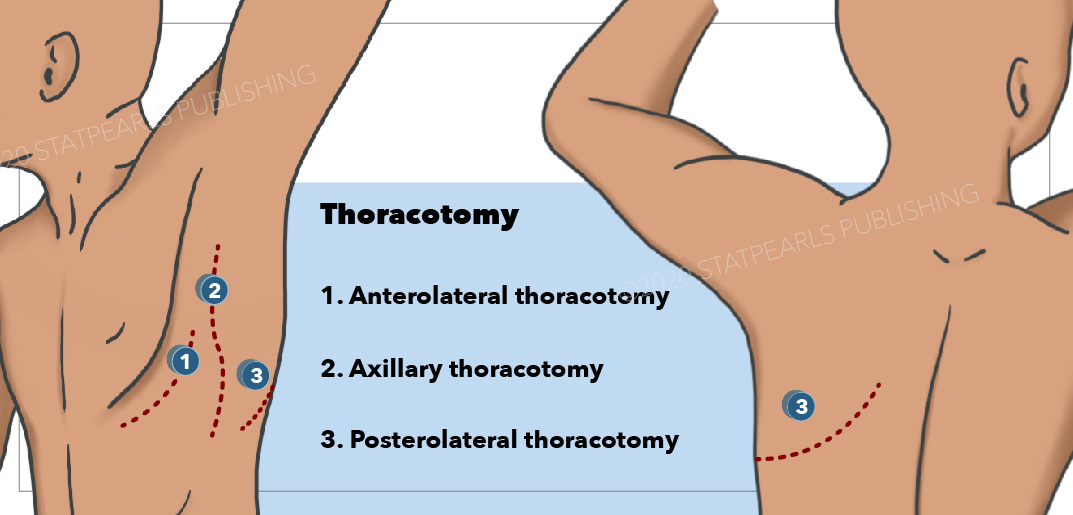 <p>Thoracotomy