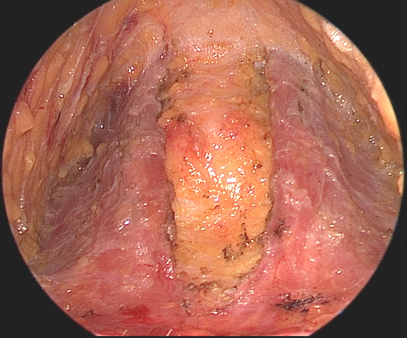 Endoscopic view of the platysma, demonstrating midline dehiscence of the muscles