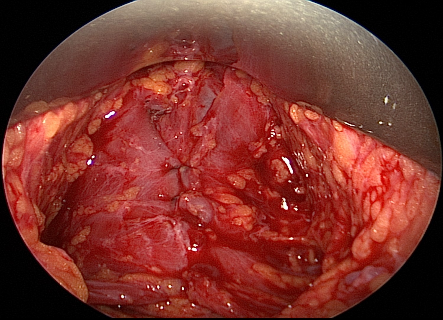 Endoscopic view of the platysma after suturing the left and right sides together in the midline, which will decrease appearance of vertical bands in the neck