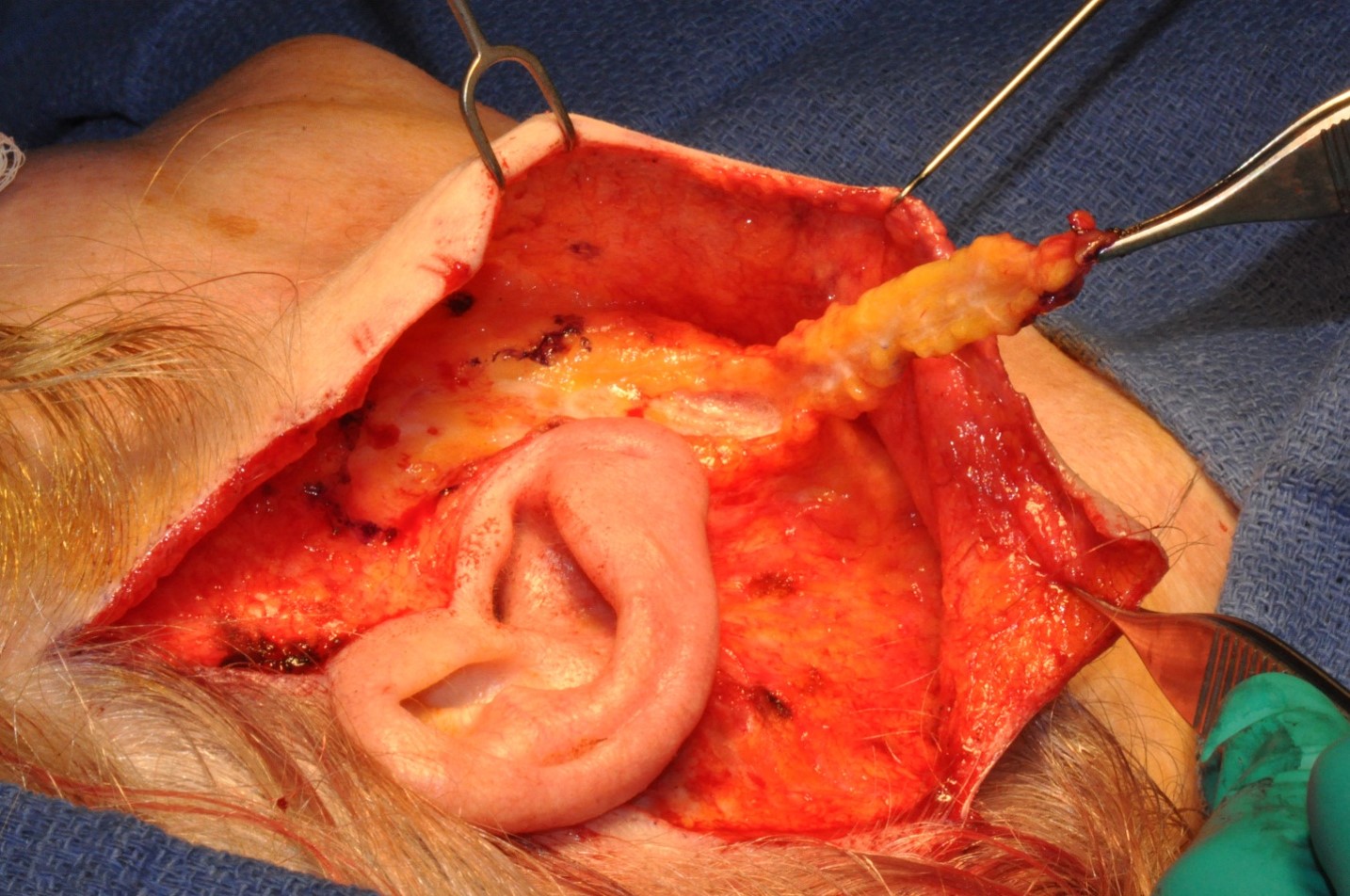 <p>SMAS Flap