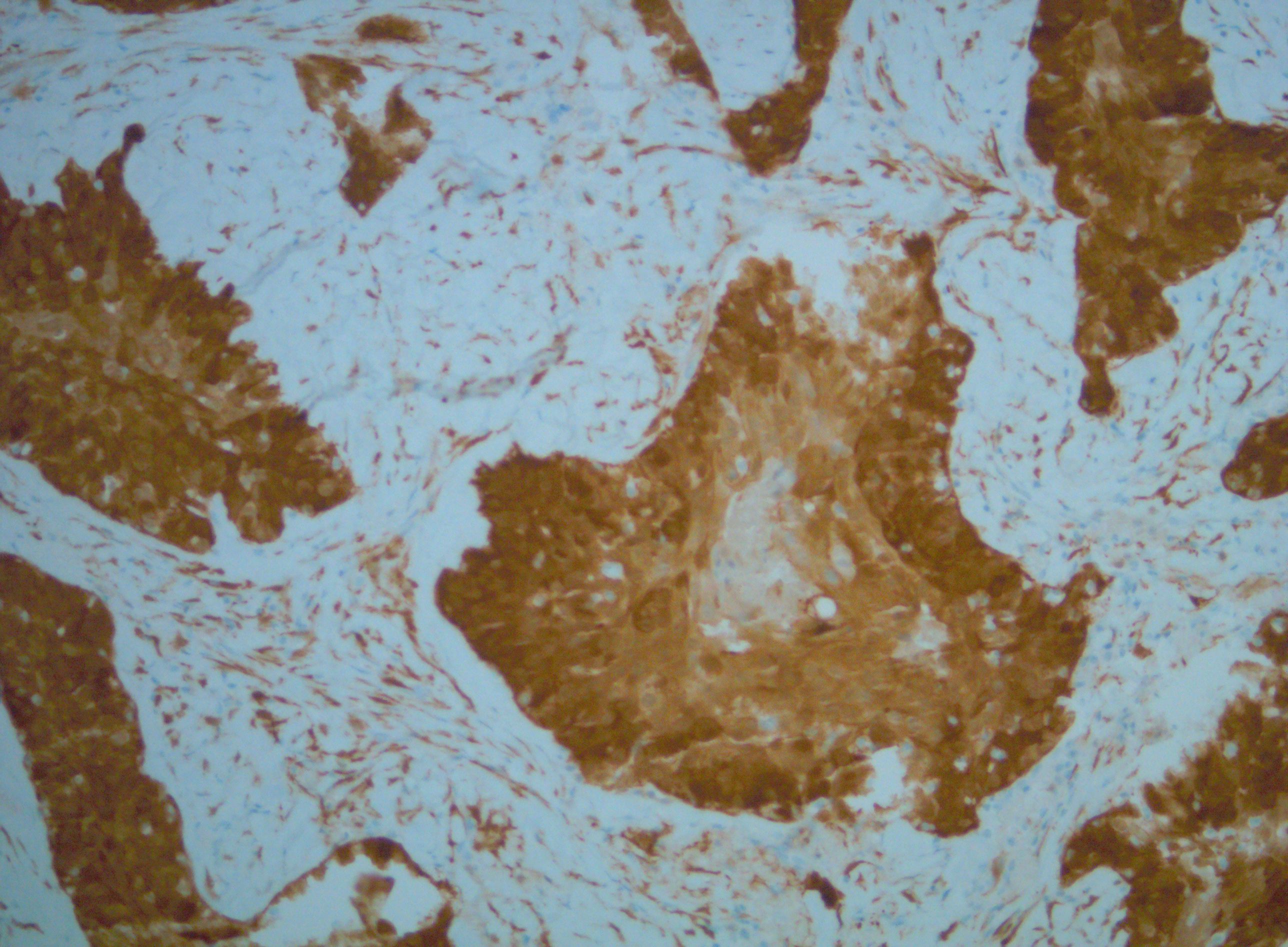 HPV-positive Squamous Cell Carcinoma (SCC) of the Palate with P16 (+) staining
