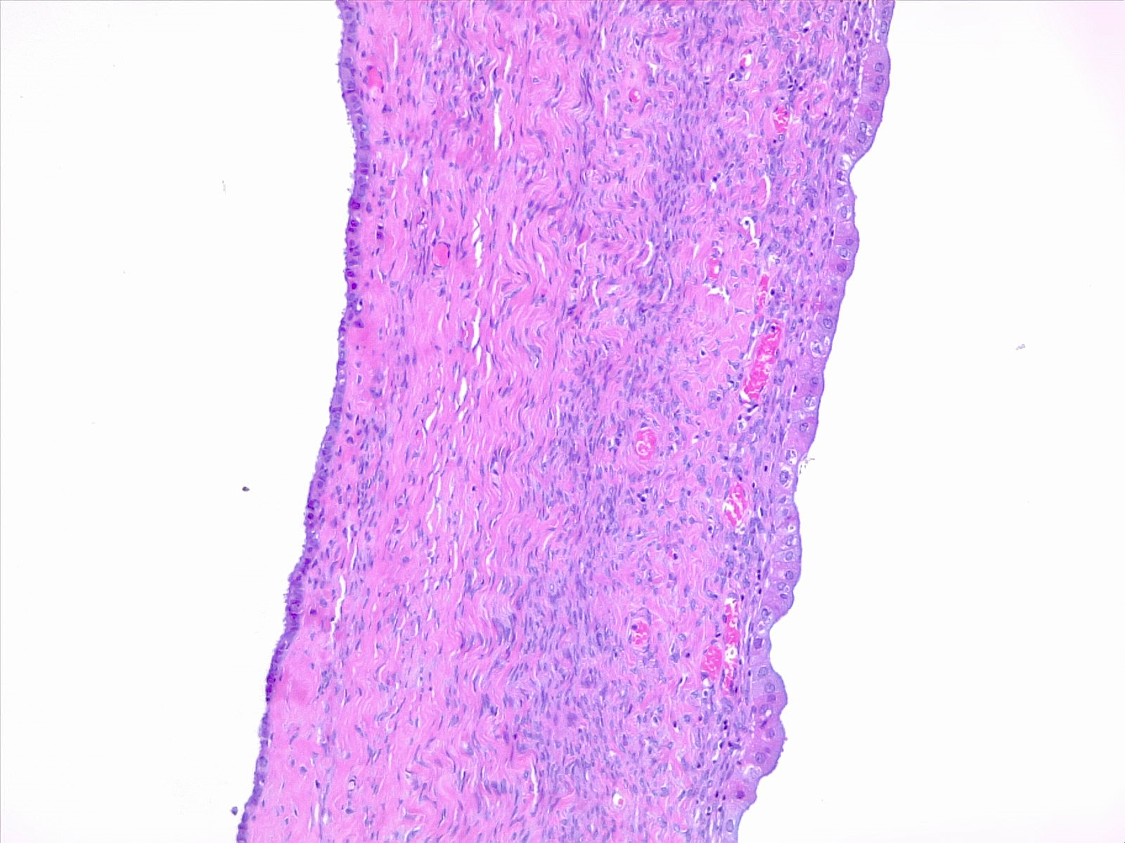 Serous cystadenoma, multiloculated cyst wall with monostratified serous epithelium. 10x H/E stain.