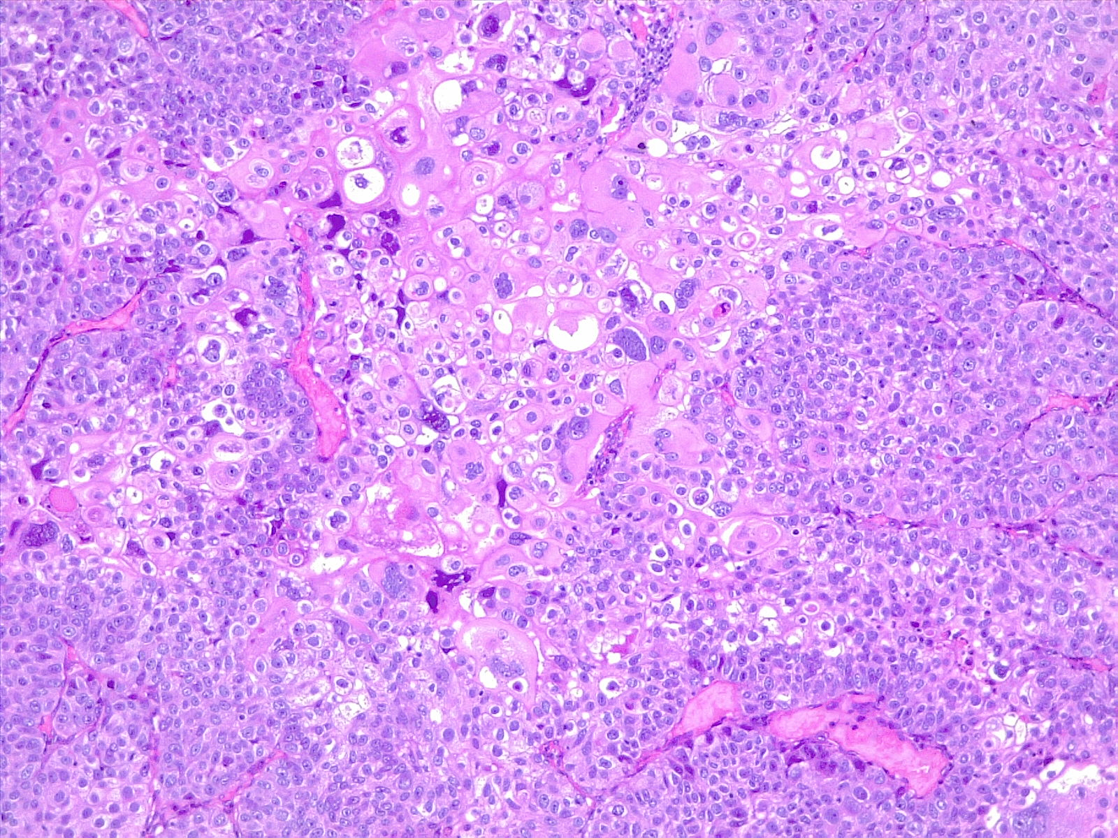 Poorly differentiated urothelial carcinoma, with metaplastic squamous appearance. 10x, H/E.